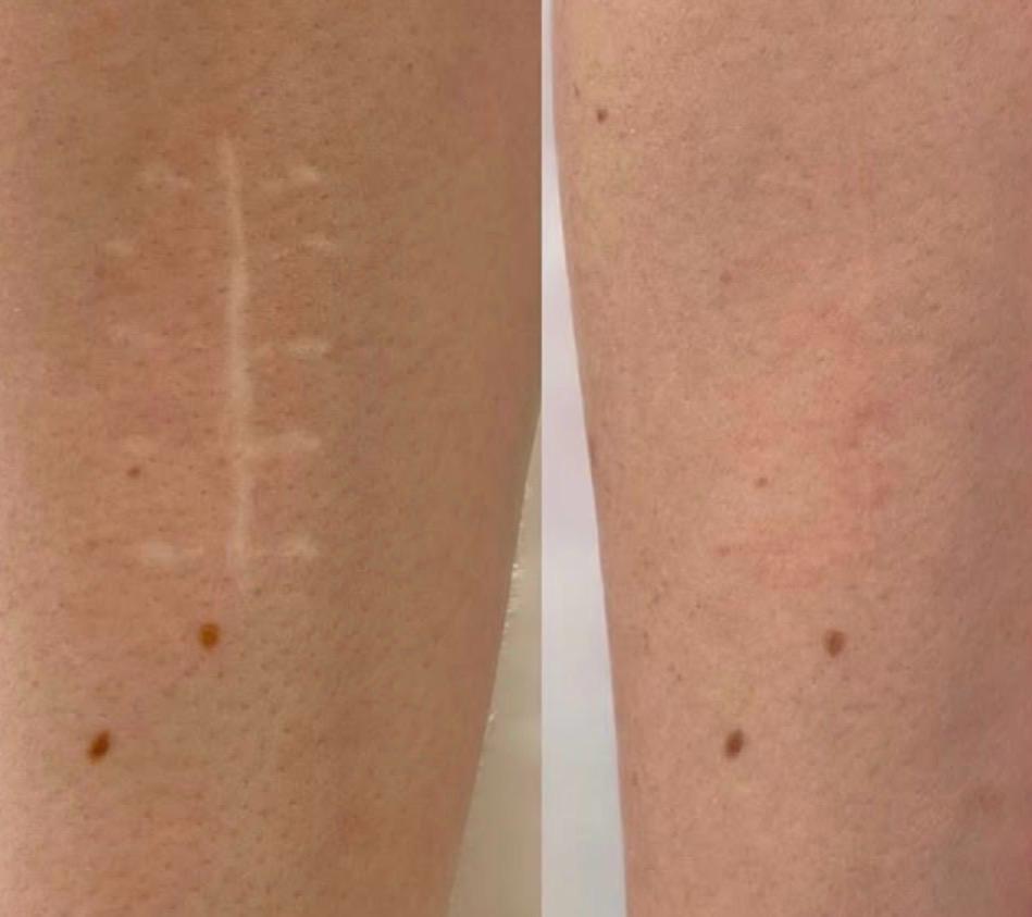 Antes e depois — camuflagem de cicatriz na panturrilha