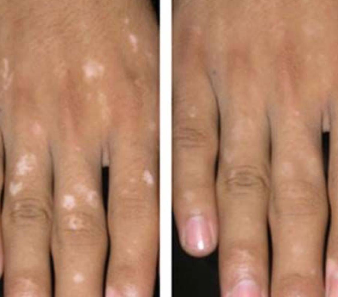 Antes e depois — manchas de pele nas mãos