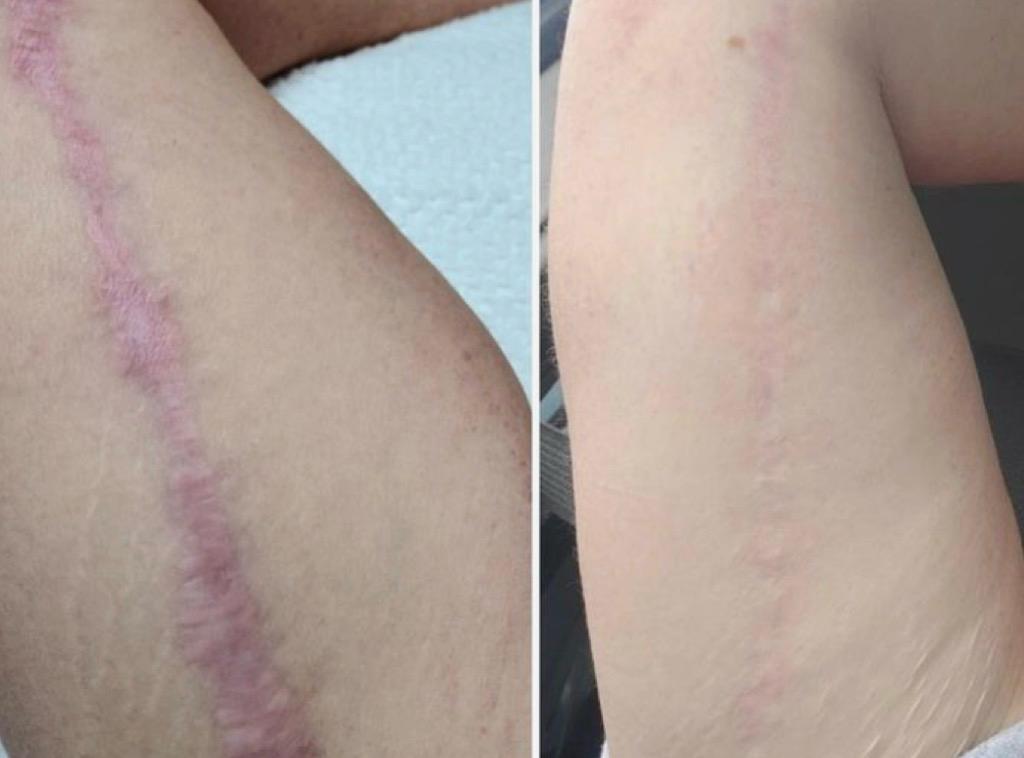 Antes e depois — camuflagem de cicatriz extensa